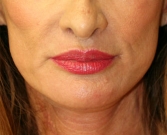 Feel Beautiful - Lips San Diego Case 16 - After Photo